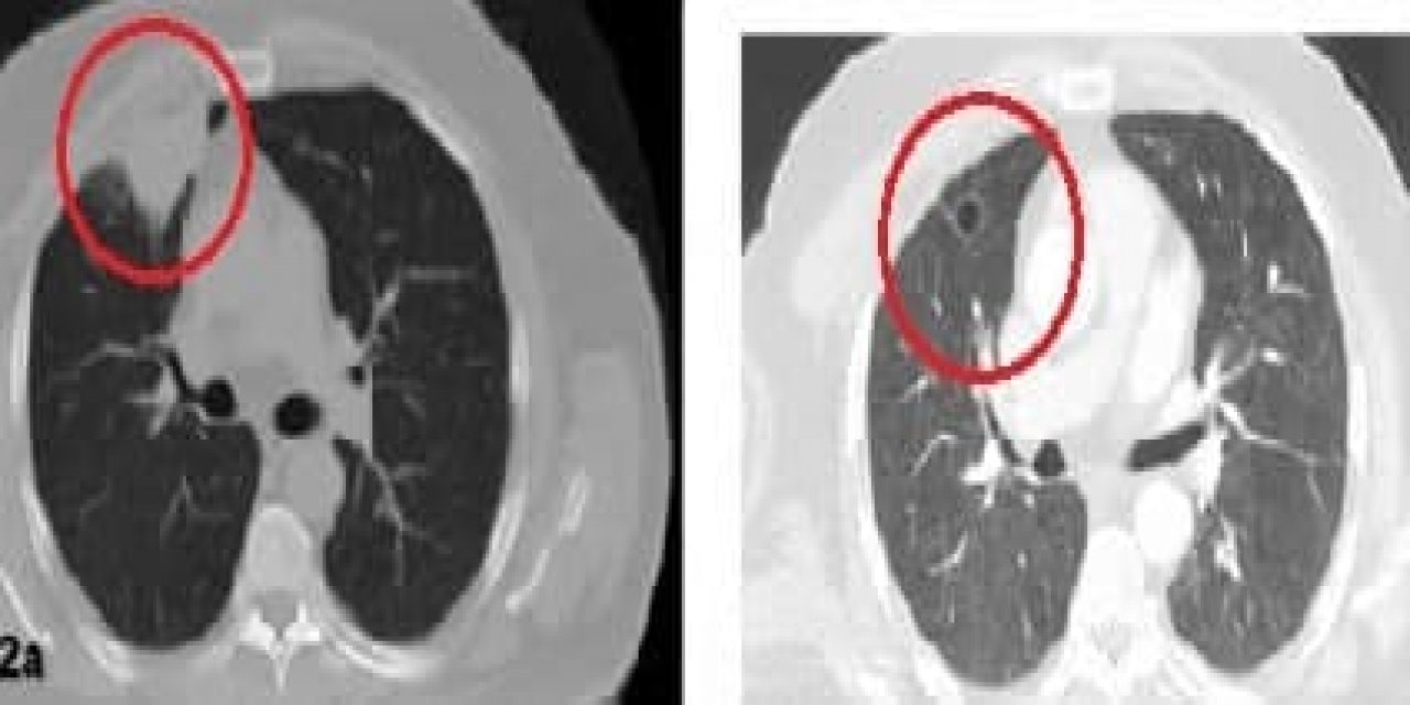 Korona virüs akciğer kanserini taklit etti 